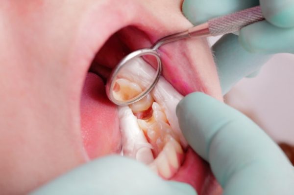 i-have-a-cavity-how-long-can-i-wait-to-have-it-filled-dentistry-on-7