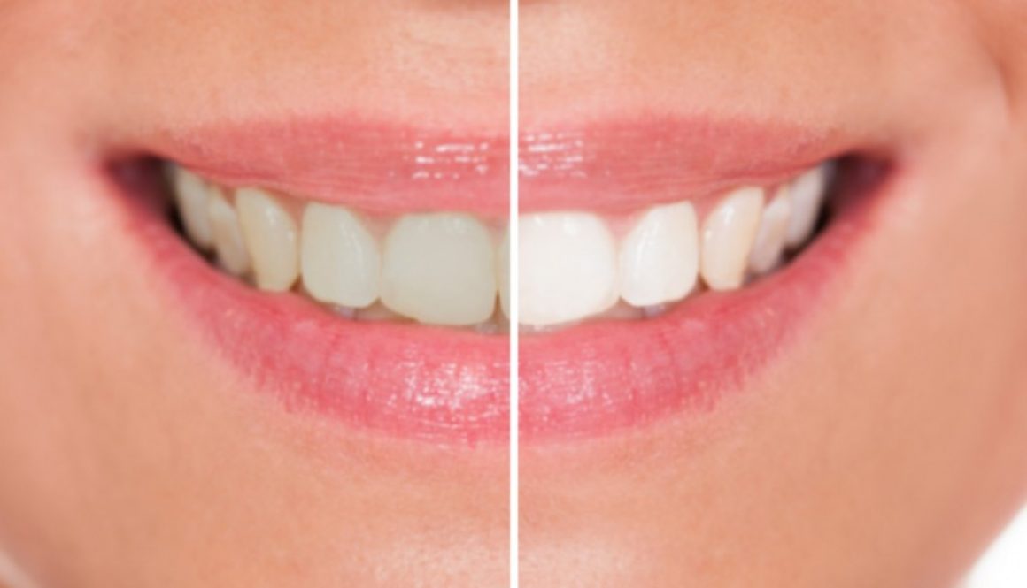 teeth-whitening-dentistryon7