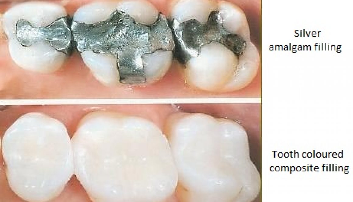 white-fillings-dentistryon7