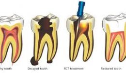 root-canal-treatment-dentistryon7