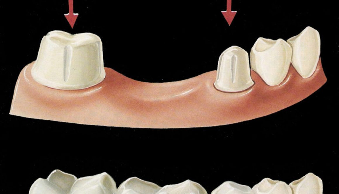 crown-bridge-dentistryon7