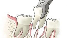 tooth-extraction-dentistryon7